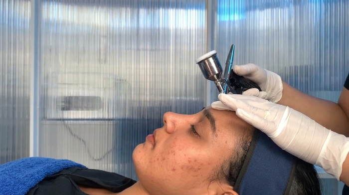 Best acne treatment clinics in Surat 2026