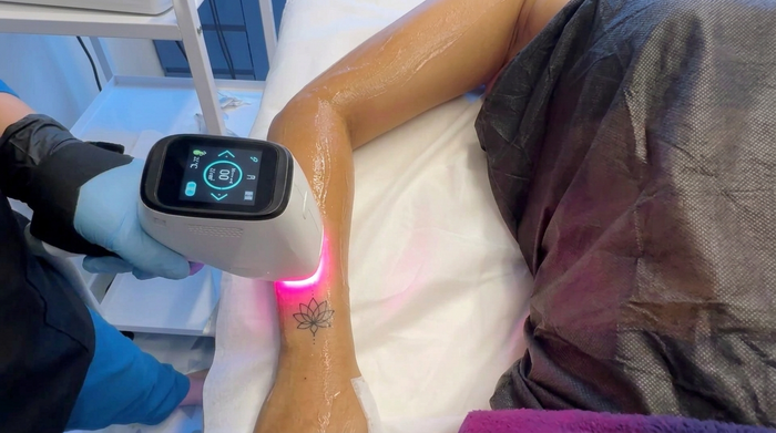 Laser Hair Removal Around Tattoos: What Can Be Treated Safely?