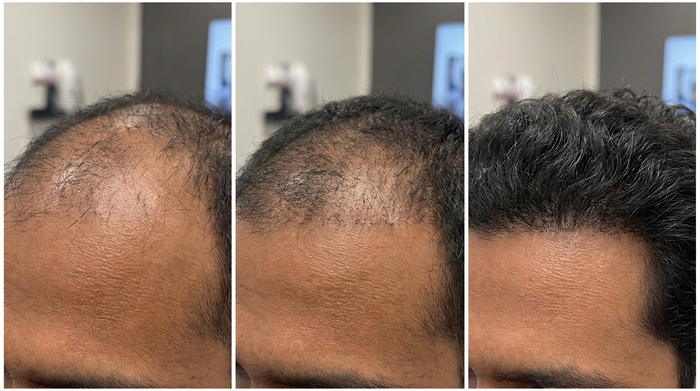 Shedding After Starting Minoxidil: What to Expect and When to Seek Help