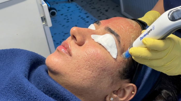 Acne Scar Treatment for Indian Skin: How to Reduce Pigment Risk