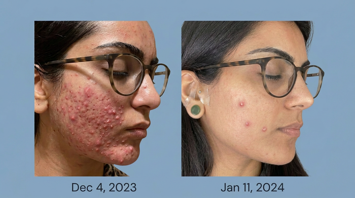 Acne Returning After Isotretinoin: What Does Relapse Mean?