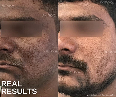 Acne + Texture — before and after treatment result