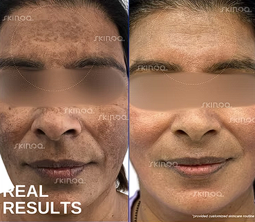 Pigmentation Correction — before and after treatment result