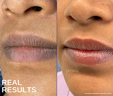 Acne Scars — before and after treatment result