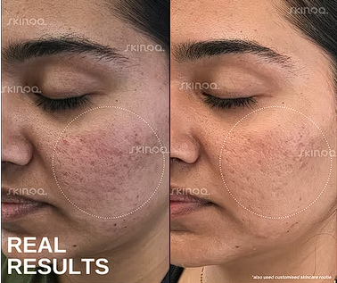 Skin Clarity — before and after treatment result