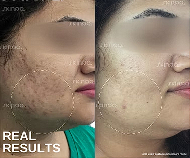 Texture Refinement — before and after treatment result